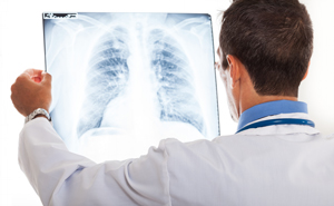 Photo of a male Physician holding up an x-ray of the chest and rib area.
